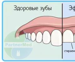 Bruksizam ili škrgutanje zubima