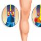 女性の足の静脈瘤：最初の兆候、原因、そして最良の薬と民間療法による自宅治療